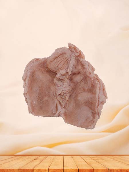 Soft Simulated Pathology Duodenal Ulcer Silicone Model