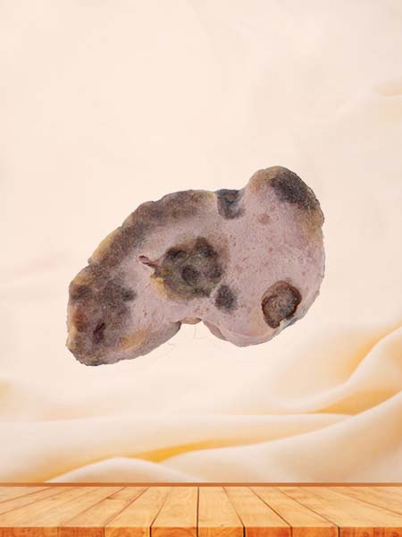 Soft Simulated Female Ovarian Cancer Model