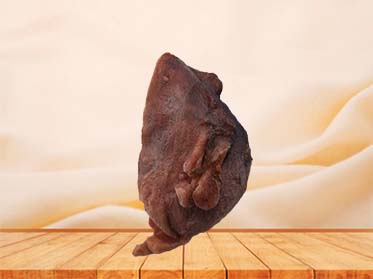 Multiple Uterine Fibroids Model