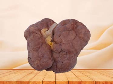 Renal Tuberculosis Model