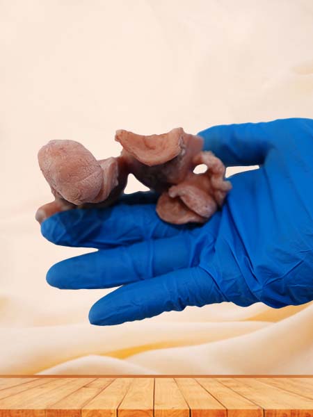 Soft Simulated Female Uterine Leiomyoma Model