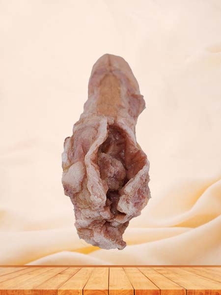 High Simulation Silicone Esophageal Cancer Model