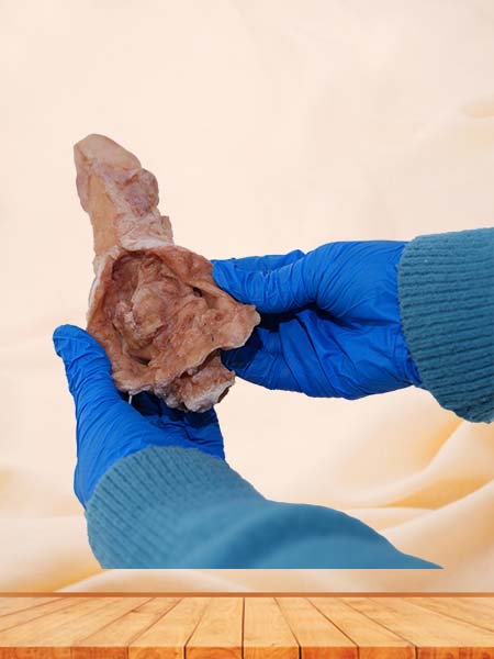 High Simulation Silicone Esophageal Cancer Model