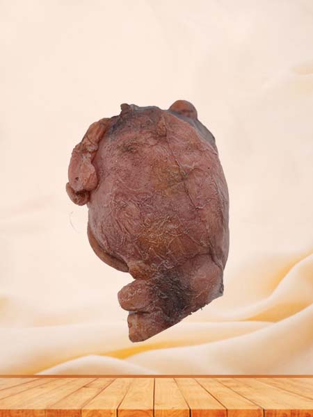Soft Simulated Female Multiple Uterine Fibroids Anatomy Model