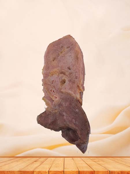 Soft Simulated Human Pulmonary Abscess Complicated by Pulmonary Carnification‌ Anatomy Model