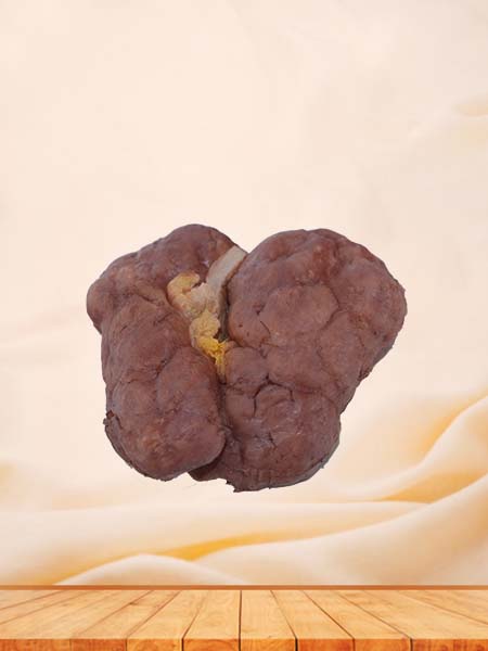 High Simulation Silicone Renal Tuberculosis Model