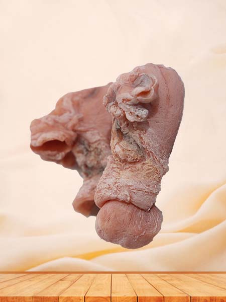 Soft Simulated Female Uterine Leiomyoma Model