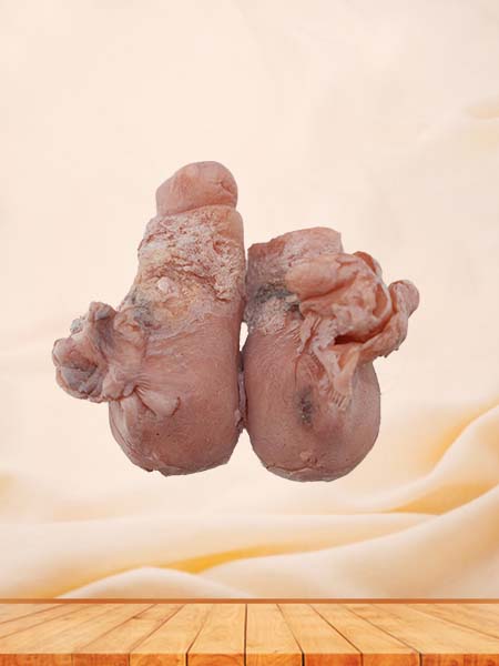 Soft Simulated Female Uterine Leiomyoma Model