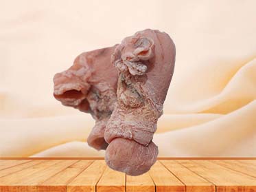 Uterine Leiomyoma Anatomy Model