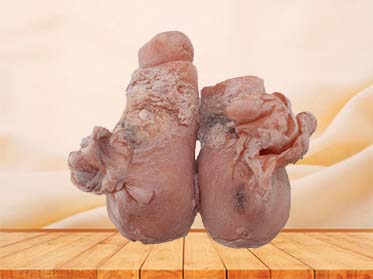 Uterine Leiomyoma Model